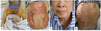 Toxic epidermal necrolysis caused by viral hepatitis A: a case report and literature review
